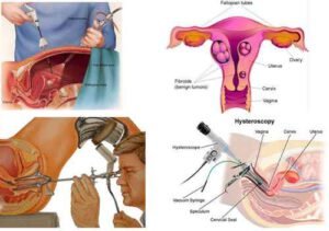 hestroscopy-surgery-in-neyveli-sns-hospital